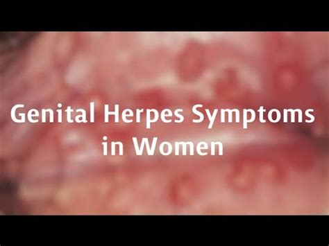 clitoral herpes|herpes on labia minora.